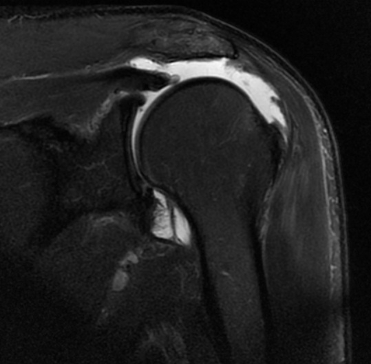 Supraspinatous Tear Retraction to Glenoid